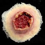 Gunshot Exit Wound, Large