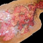Third-Degree Chest Burn