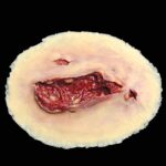 Laceration, Large