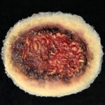 Thermal Burn, Large